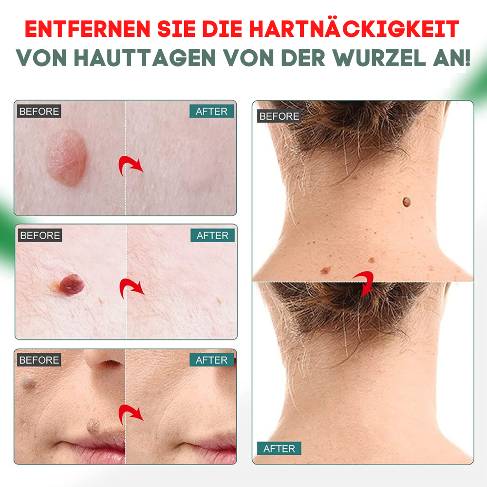 SmoothSkinX - Schmerzfrei Skin Tag Entferner & Warzenöl